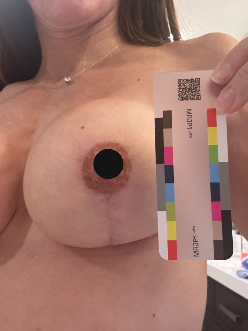 Original day 88 photo as taken, September 14, 2026: the same scar. The nipple is covered with a black circle for privacy.