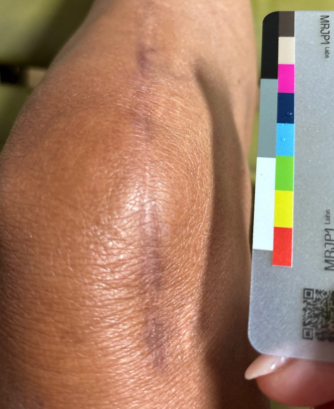 Participant photo, baseline, August 12, 2026: knee with a long vertical surgical scar and the MRJP1 color card.