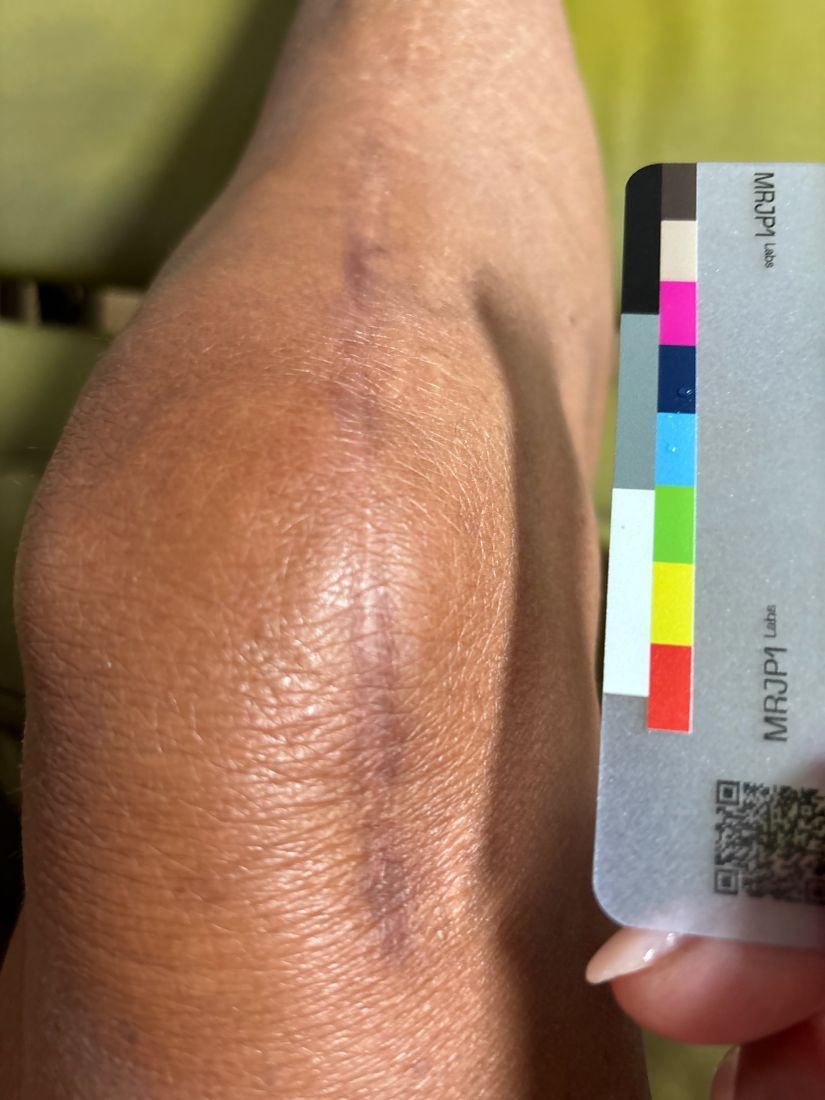Original baseline photo as taken, August 12, 2026: knee with a long vertical surgical scar and the MRJP1 color card.