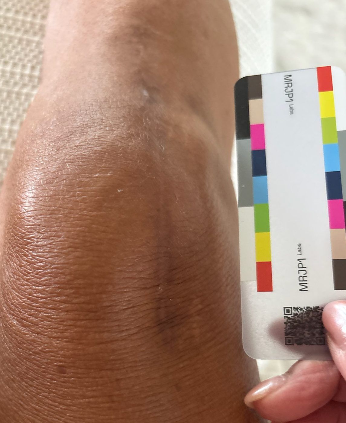 Participant photo, day 47, September 28, 2026: the same scar.