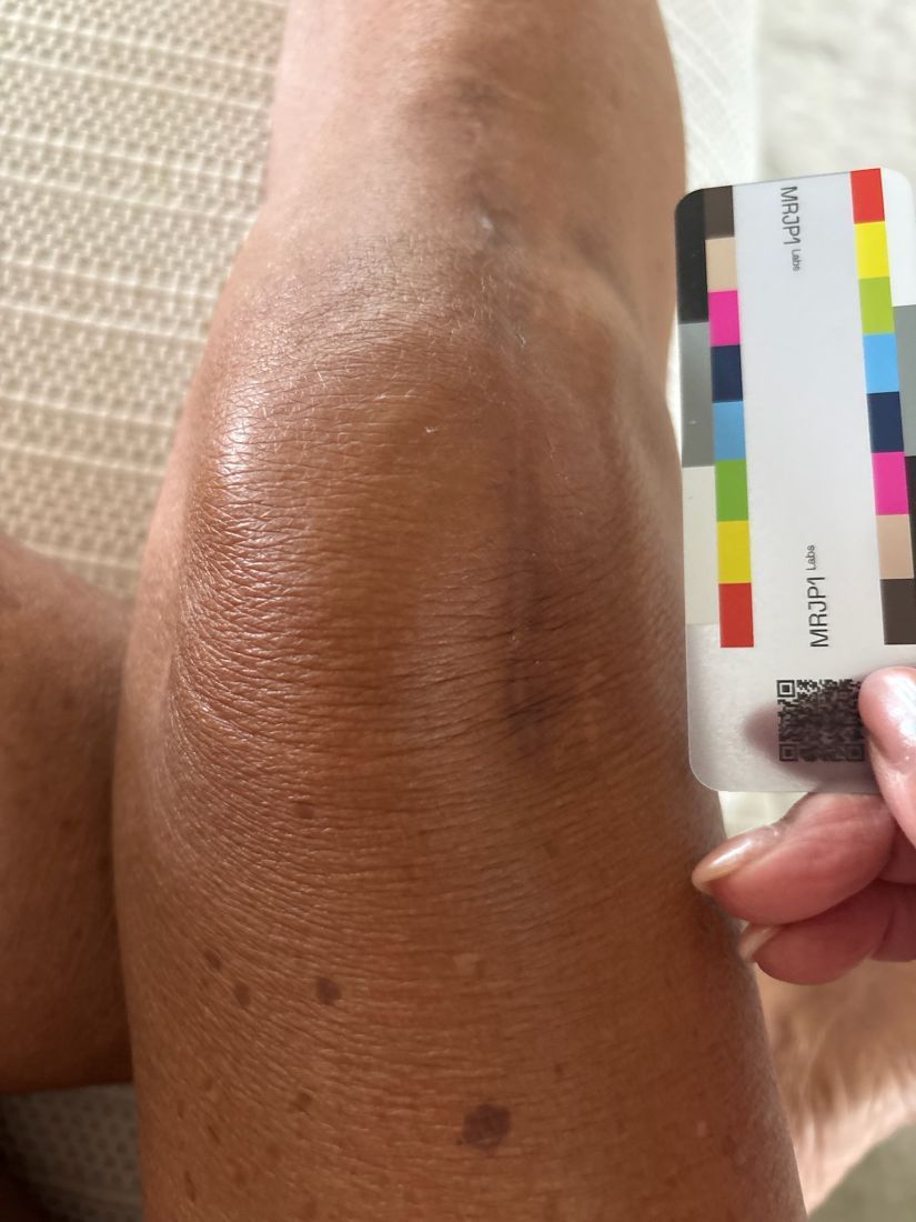 Original day 47 photo as taken, September 28, 2026: the same scar.