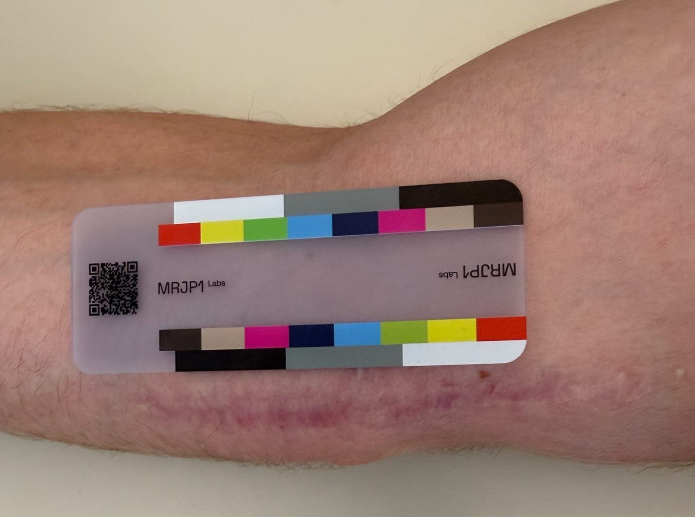 Participant photo, baseline, August 20, 2026: forearm with a horizontal surgical scar below the MRJP1 color card.