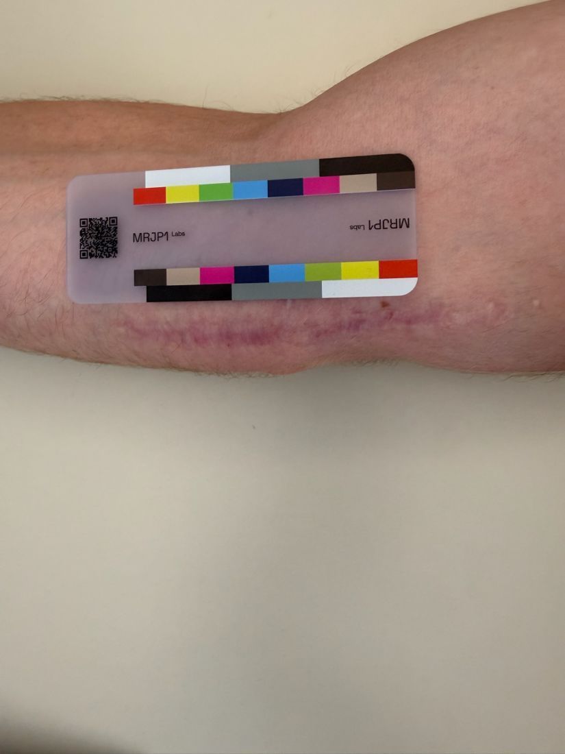 Original baseline photo as taken, August 20, 2026: forearm with a horizontal surgical scar below the MRJP1 color card.