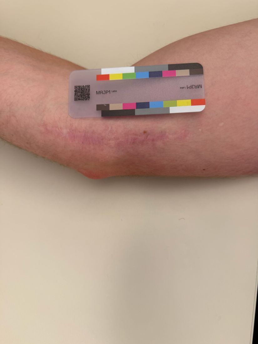 Original day 28 photo as taken, September 17, 2026: the same scar.