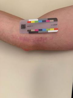 Cohort 0 participant photo, day 28, September 17, 2026: the same scar.