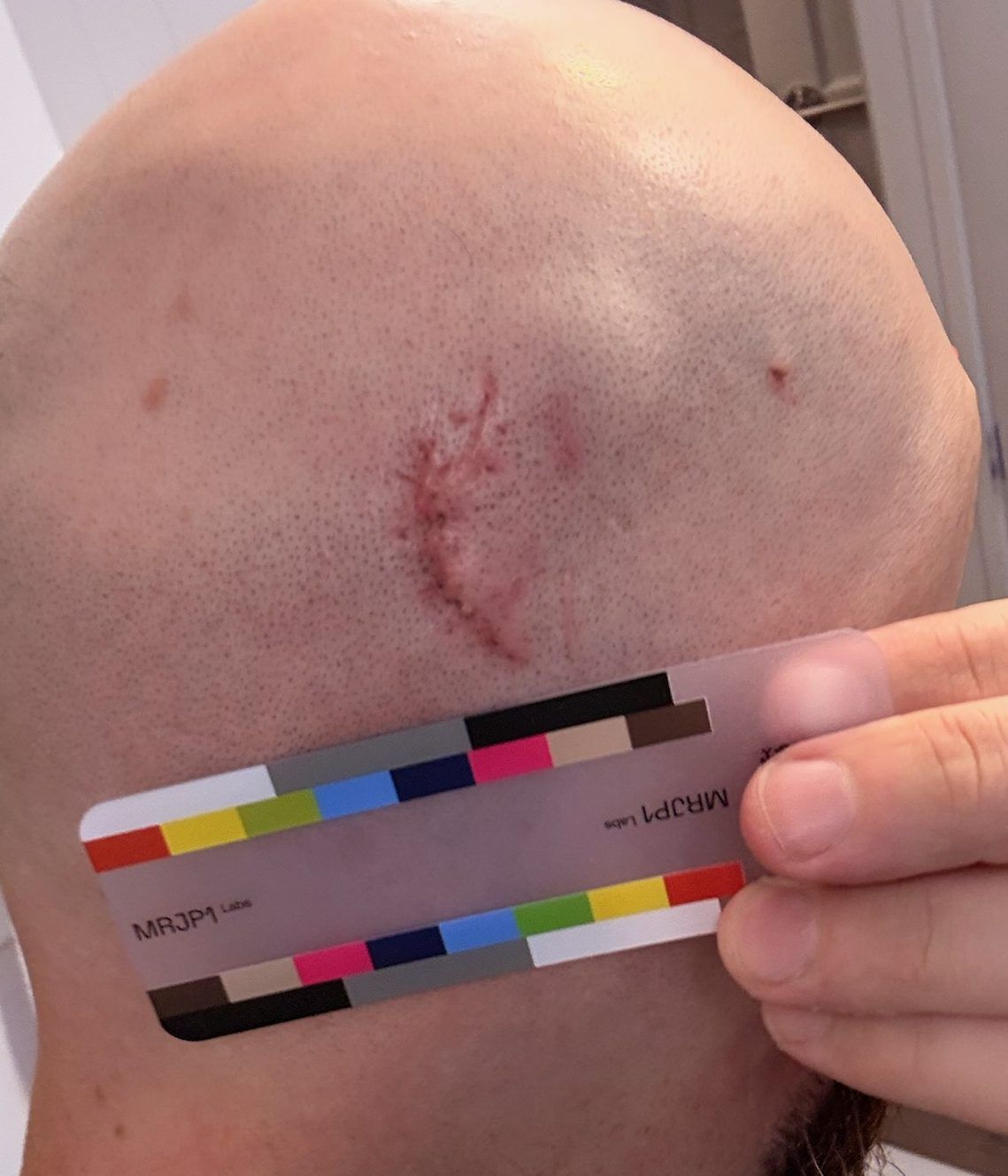 Participant photo, baseline, July 4, 2026: back of the head with a curved trauma scar above the MRJP1 color card.