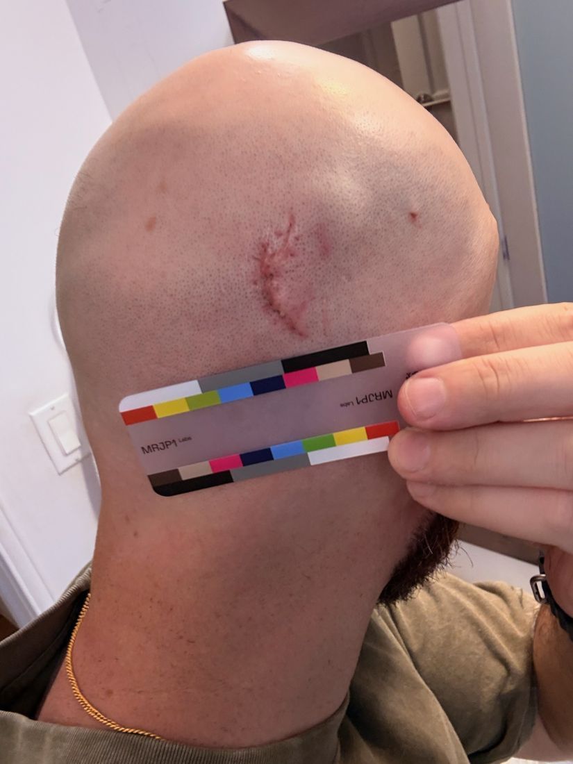 Original baseline photo as taken, July 4, 2026: back of the head with a curved trauma scar above the MRJP1 color card.