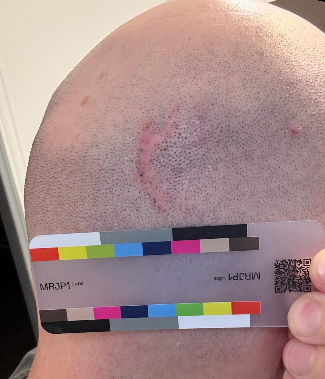 Participant photo, day 79, September 21, 2026: the same scar.