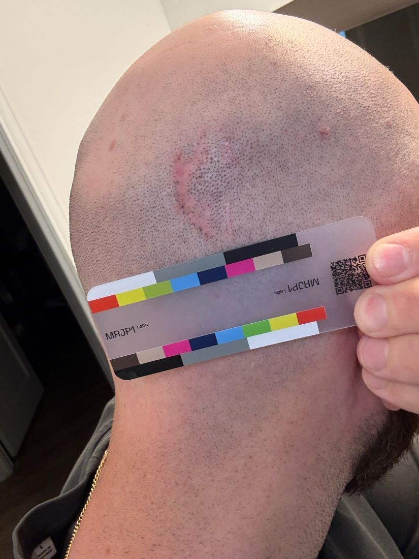 Original day 79 photo as taken, September 21, 2026: the same scar.