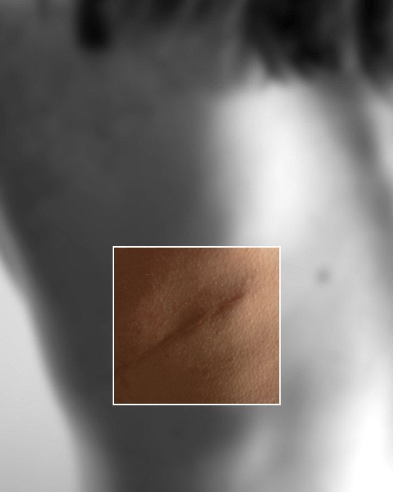 Where ScarGel is applied: soft-focus black and white view of a shoulder from behind. A sharp color window shows a diagonal scar on darker skin.