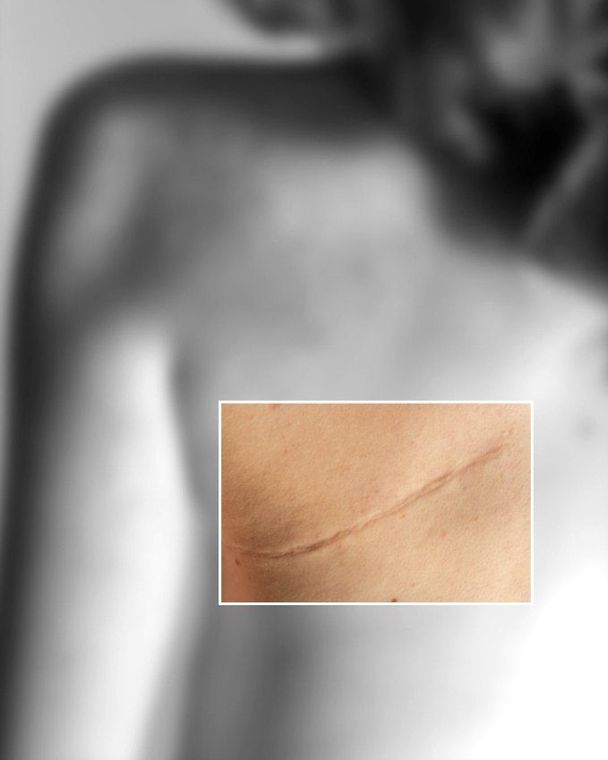 Soft-focus black and white view of a shoulder. A sharp color window shows a thin curved scar.
