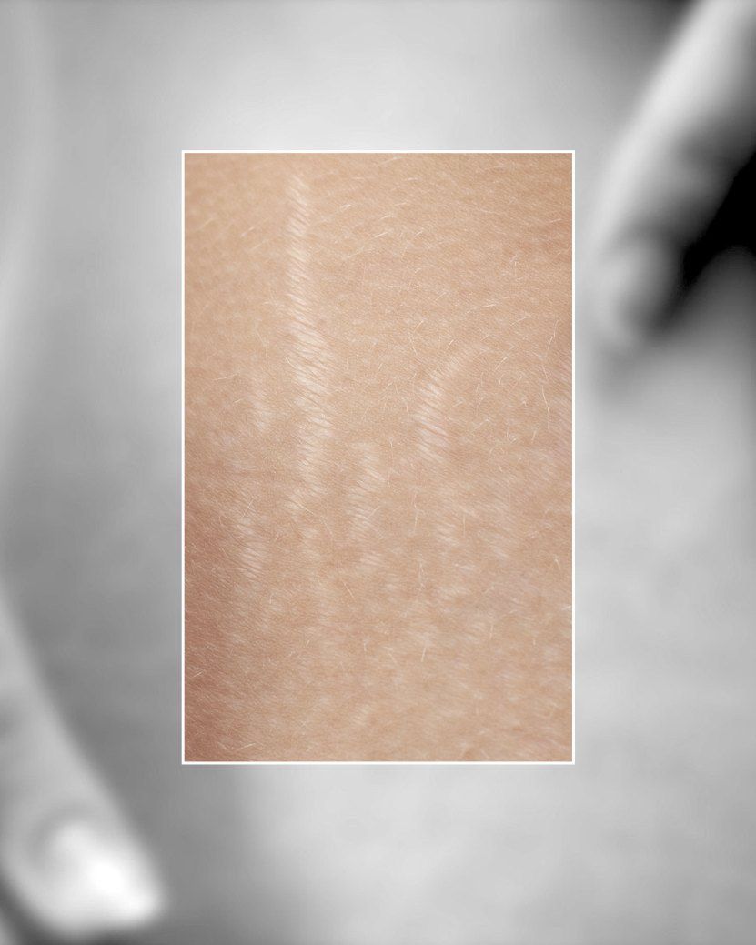 Where StretchSerum is applied: soft-focus black and white torso with hands at the edges. A sharp color window shows pale stretch marks on the skin.