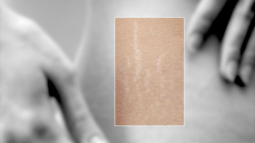 Soft-focus black and white torso with hands at the edges. A sharp color window shows pale stretch marks on the skin.