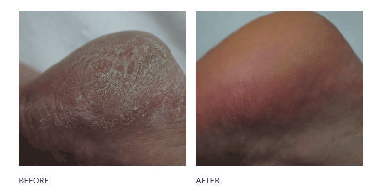 A before and after photo of a person 's foot