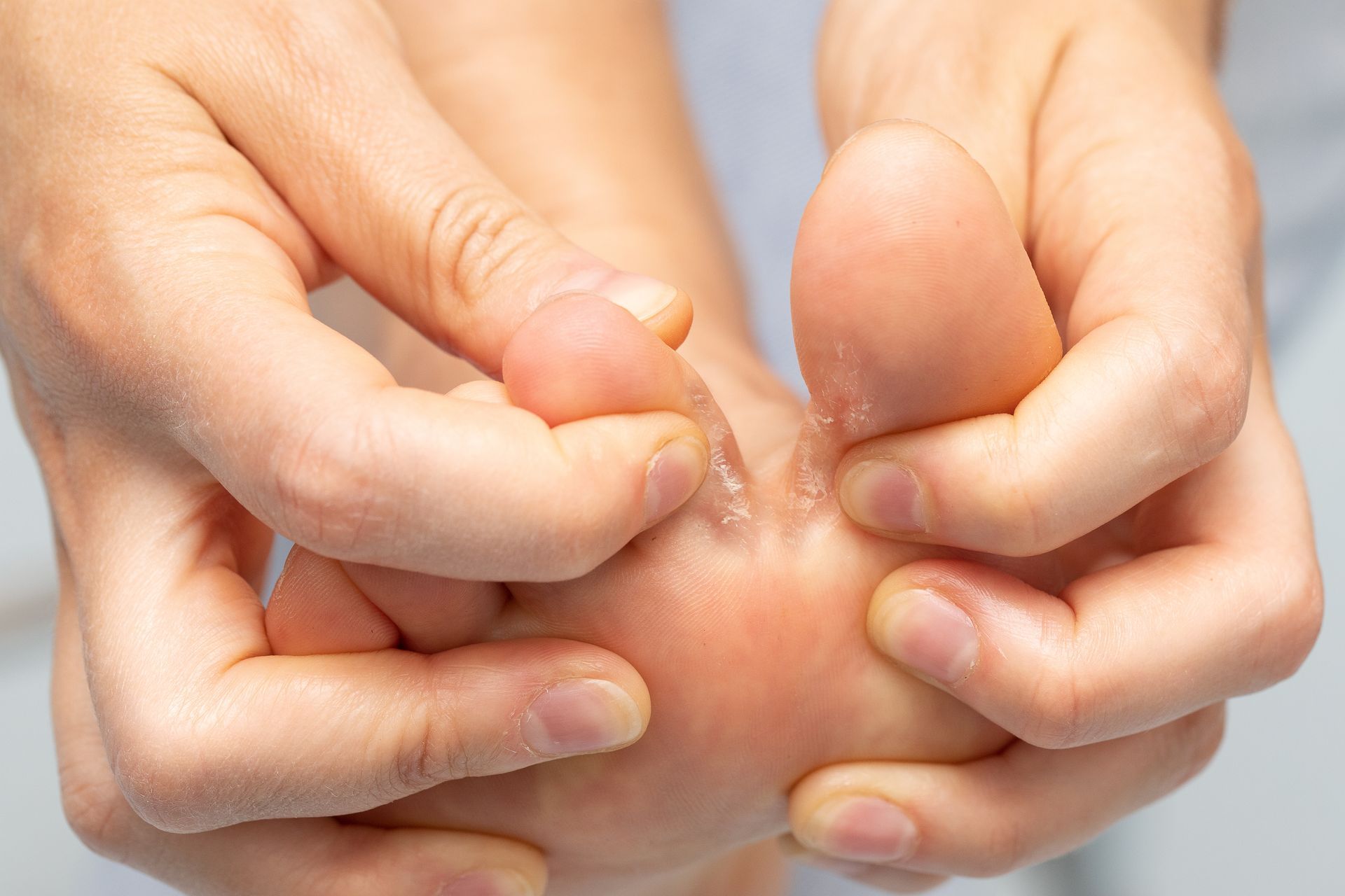Hands peeling skin off of foot, likely athlete's foot, indoors.