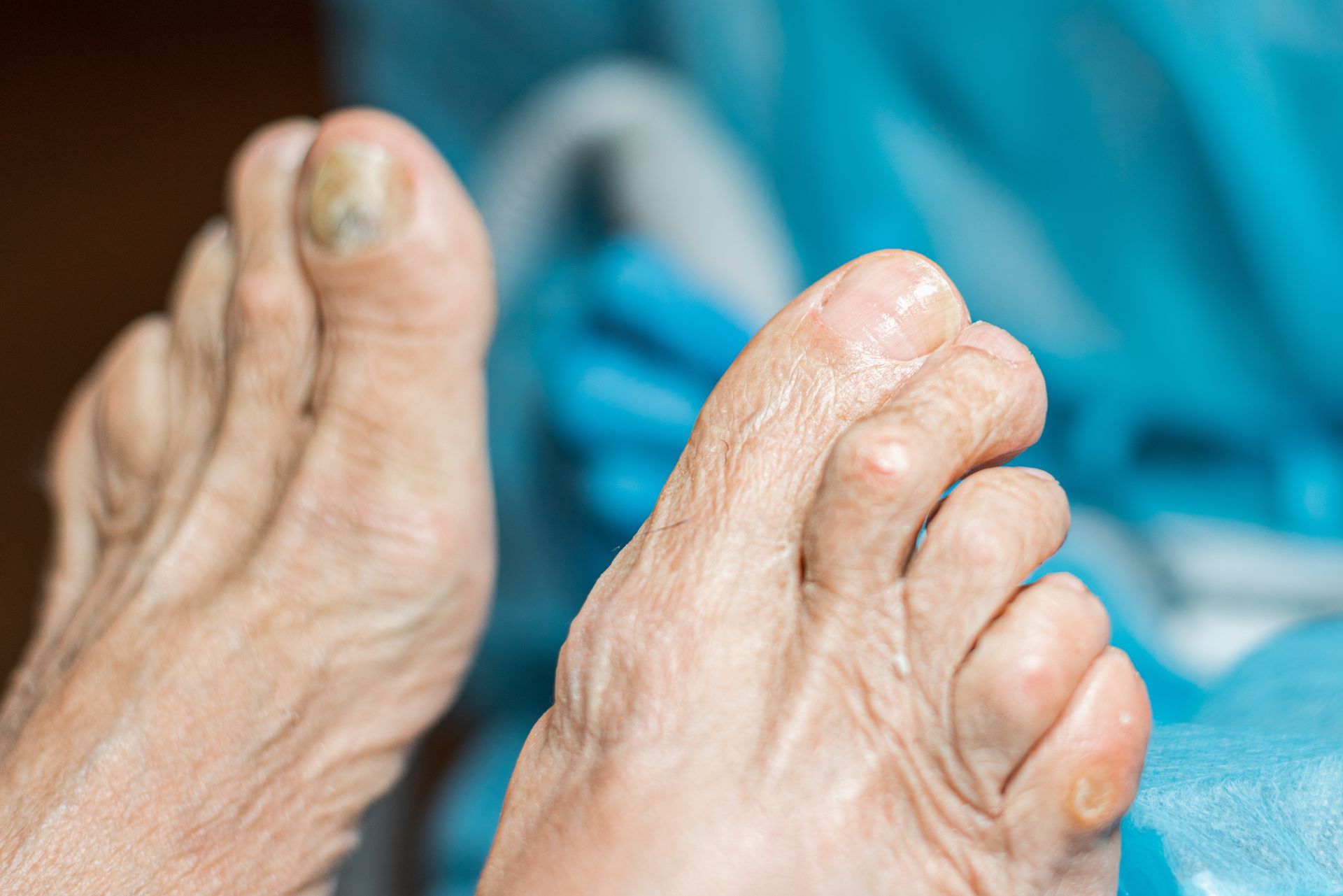 Close-up of aged feet, showing wrinkled skin and a discolored toenail, resting on a blue surface.
