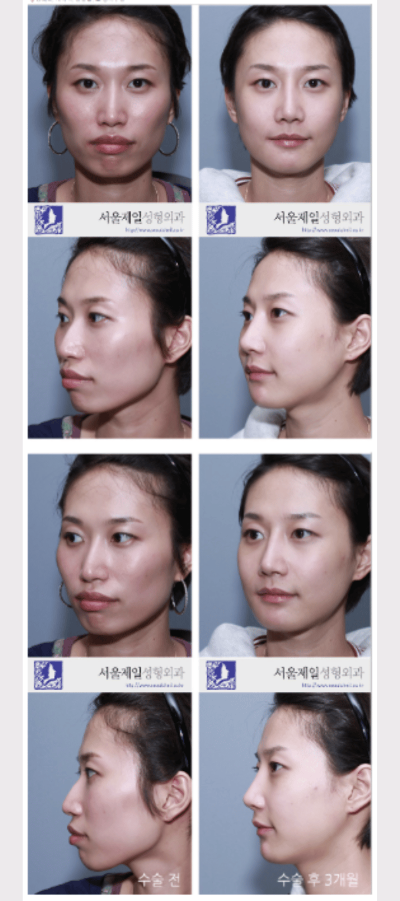 Protruding mouth surgery (ASO) before and after photos, front and side views, Seoul Cheil Plastic Surgery