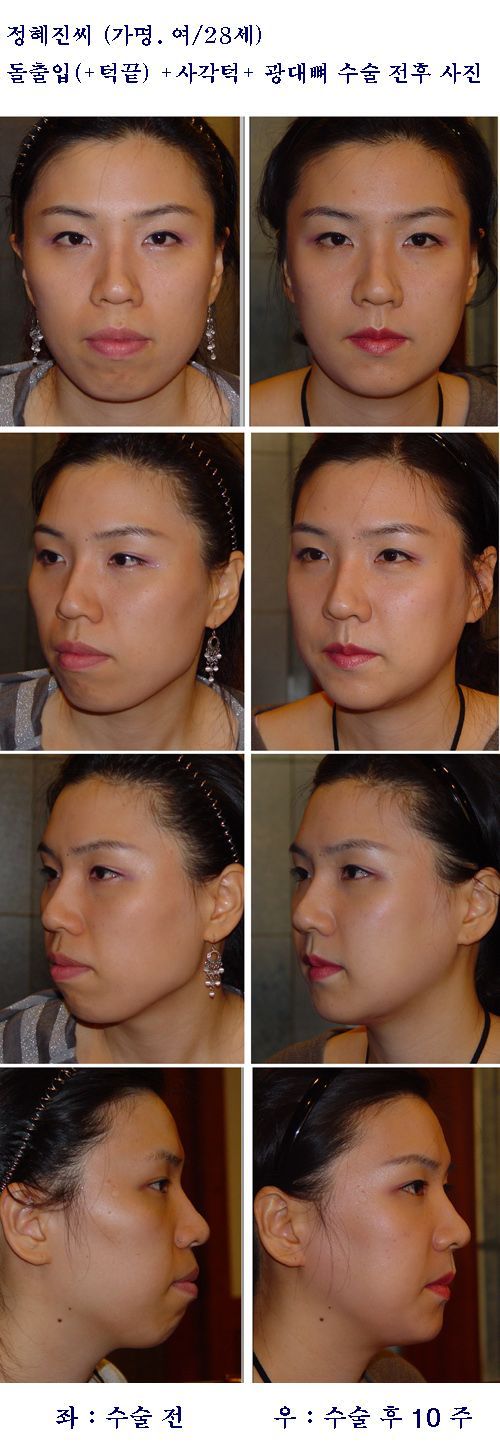 Facial contouring cheekbone and square jaw surgery before and after series, Seoul
