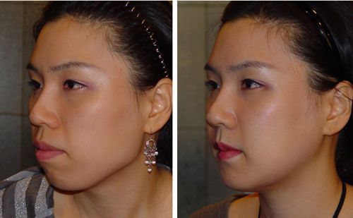 V-line facial contouring before and after side view, Seoul
