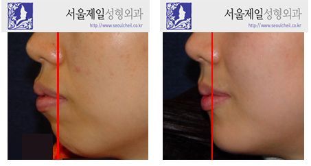 ASO plus chin advancement genioplasty before and after profile, Korea