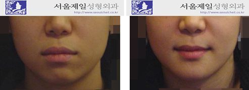 Protruding mouth surgery (ASO) only, before and after front view, Korea