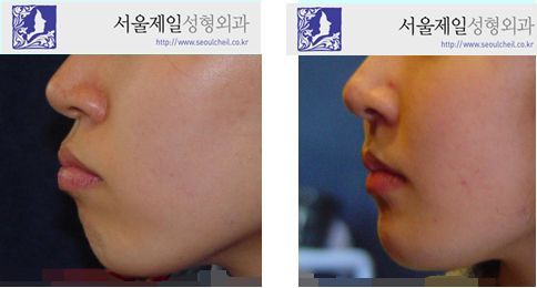 ASO with chin length reduction and advancement before and after, Seoul