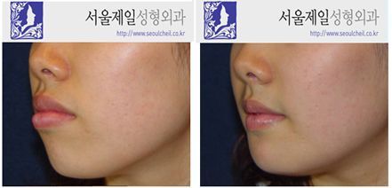 ASO with chin length reduction before and after, Seoul Cheil