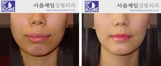 ASO and genioplasty before and after front view, Korea