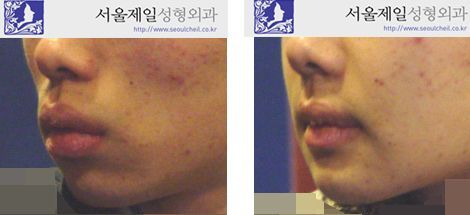 Male cheekbone reduction and protruding mouth surgery before and after, Korea