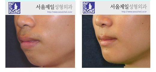 Male protruding mouth surgery before and after profile, Seoul