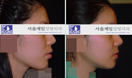 Mild protruding mouth ASO before and after, Seoul Cheil Plastic Surgery