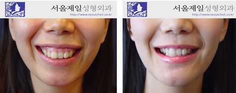 Gummy smile correction with ASO before and after smile, Seoul
