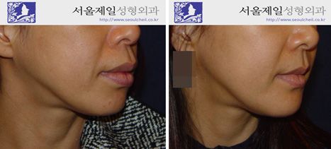 Protruding mouth surgery with long philtrum before and after, Korea