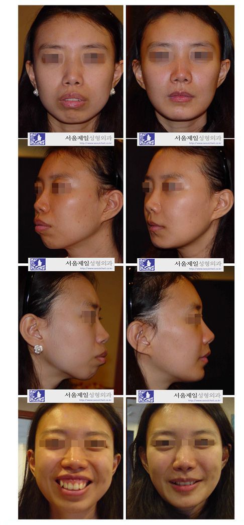 Protruding mouth surgery full before and after photo series, Seoul