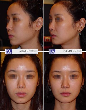Protruding mouth and square jaw surgery before and after, Korea