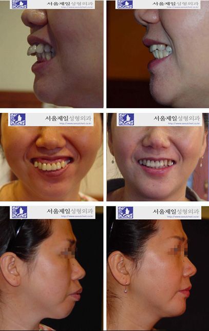 Upper jaw ASO with chin surgery before and after, Korea