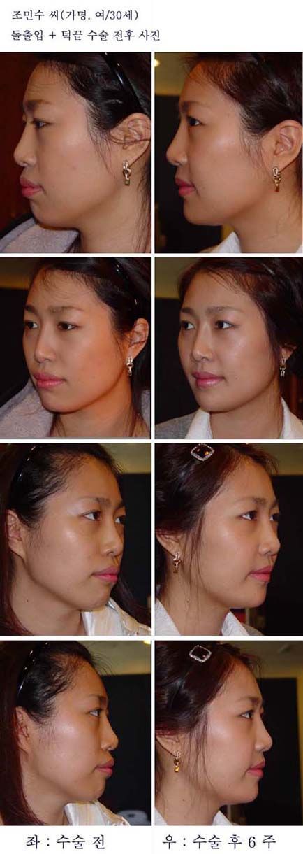 ASO and chin length reduction before and after photo series, Seoul