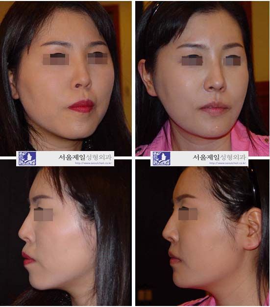Cheekbone reduction and ASO before and after, Seoul