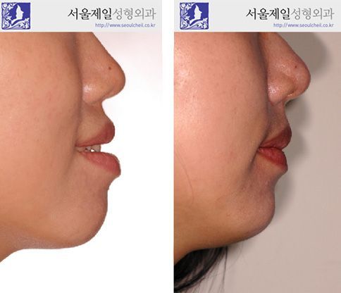 Two-jaw orthognathic surgery before and after profile, Seoul