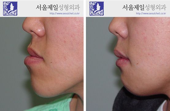 ASO as alternative to two-jaw surgery before and after, Seoul