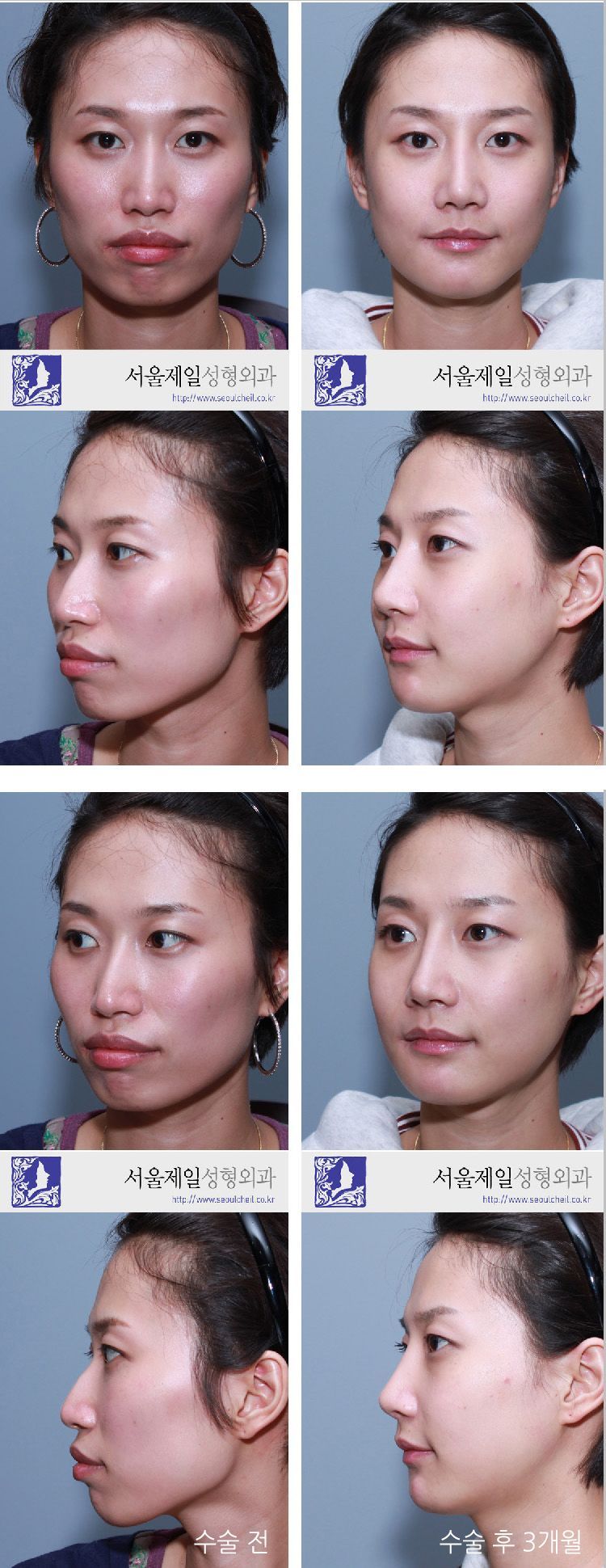 Facial contouring surgery before and after photo series, Seoul Cheil