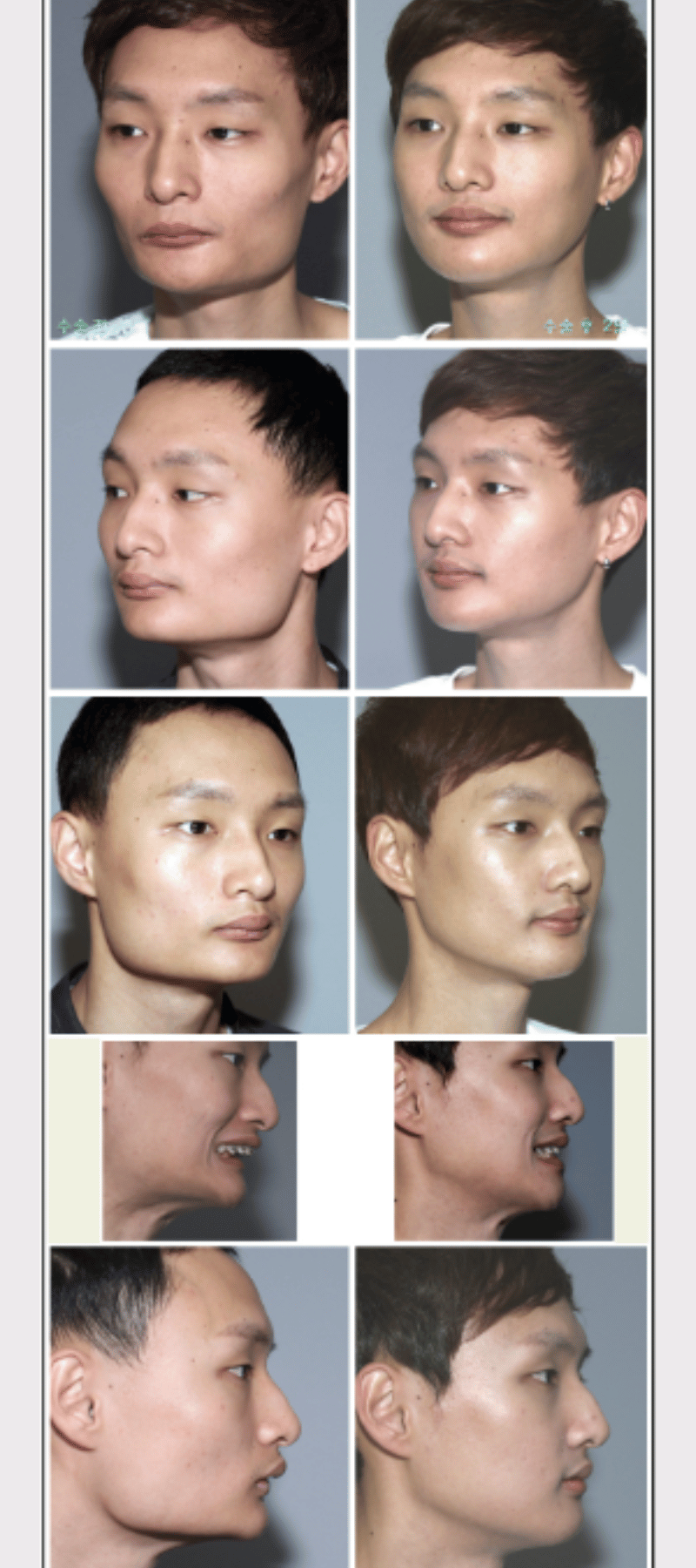 Before and after anterior segmental osteotomy (ASO) for protruding mouth in Korea, profile comparison