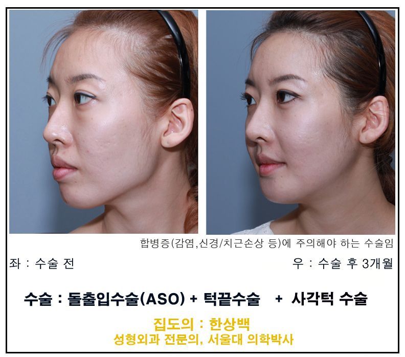 Square jaw reduction with ASO and chin surgery before and after, Korea