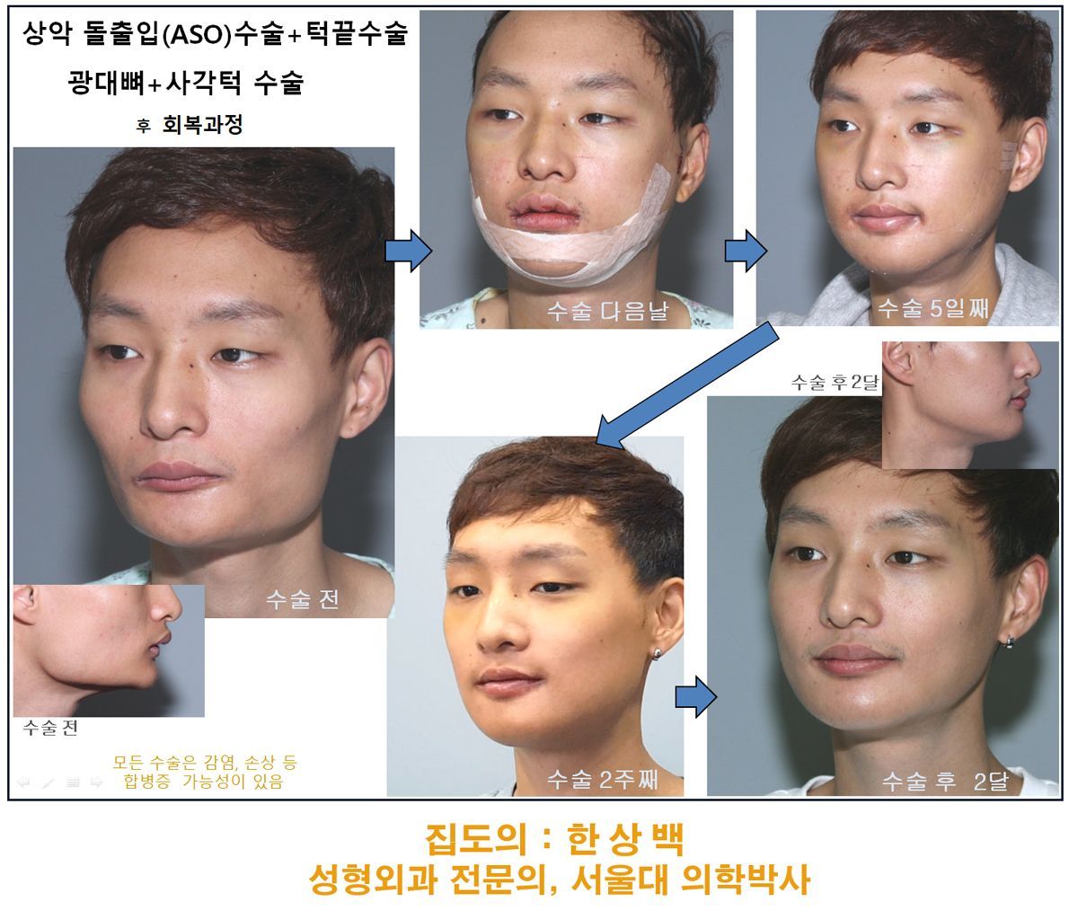 Combined facial contouring surgery before and after recovery series, Korea