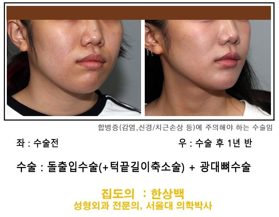 Cheekbone reduction with ASO before and after, Seoul Cheil Plastic Surgery