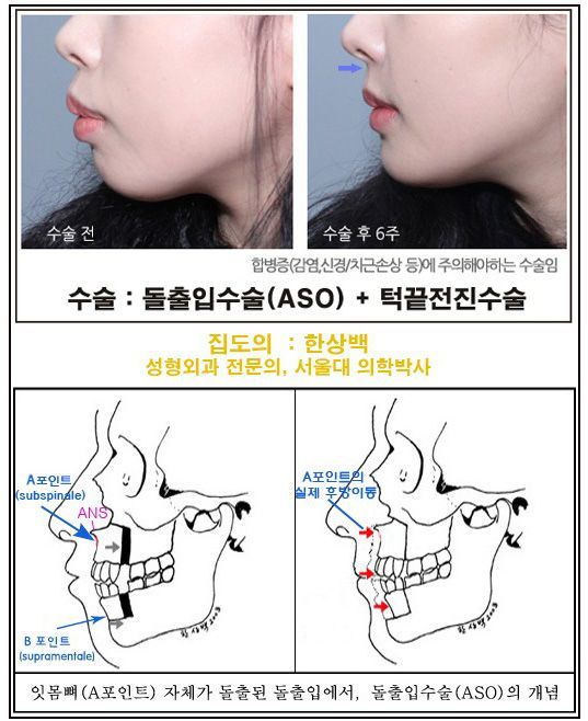 Receding chin and protruding mouth correction before and after, Seoul