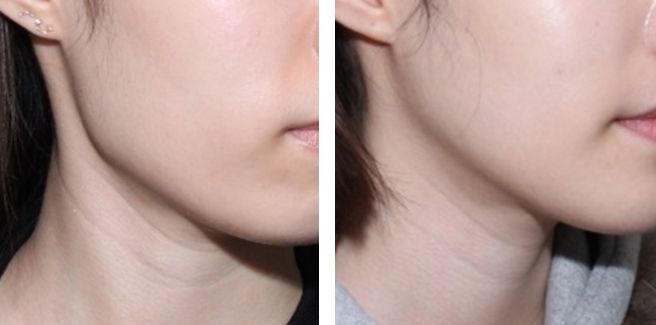 Square jaw surgery before and after jaw angle, Korea