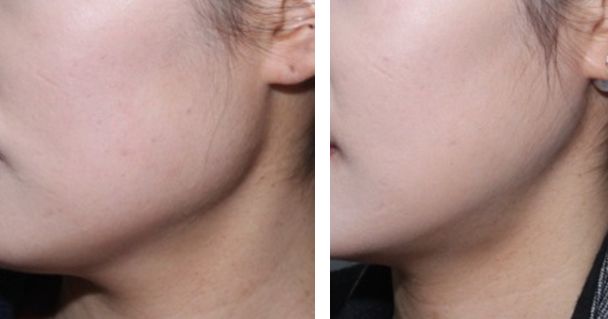 Square jaw reduction before and after side view, Seoul