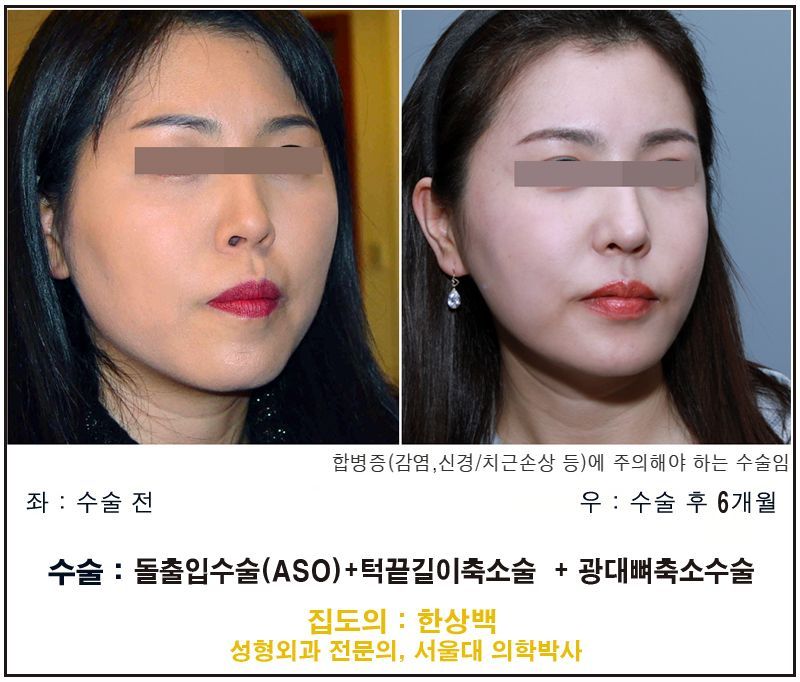 Cheekbone reduction surgery before and after front view, Korea