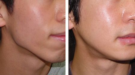 Mandible angle reduction before and after, Seoul Cheil Plastic Surgery
